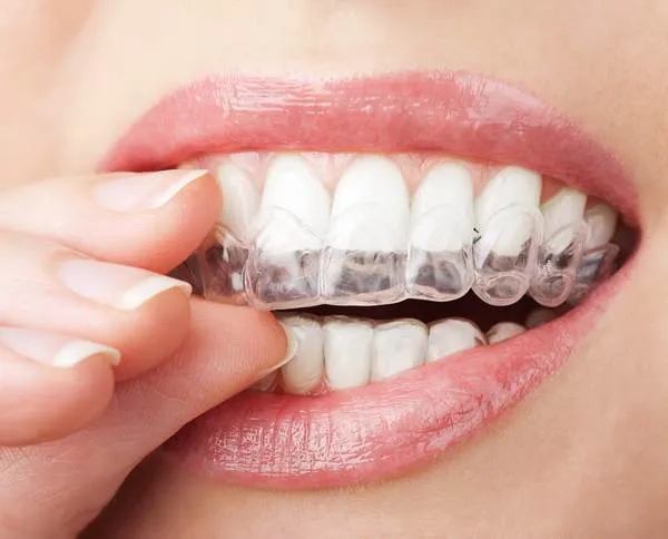 Close-up of a person inserting an Invisalign clear aligner, showcasing straight white teeth and a natural smile, relevant to the comparison of Invisalign and Smile Direct Club orthodontic treatments.